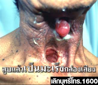 Thailand 2009 Health Effects other - lived experience, throat cancer, gross